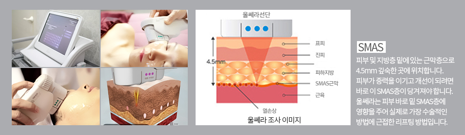 울쎄라 시술원리